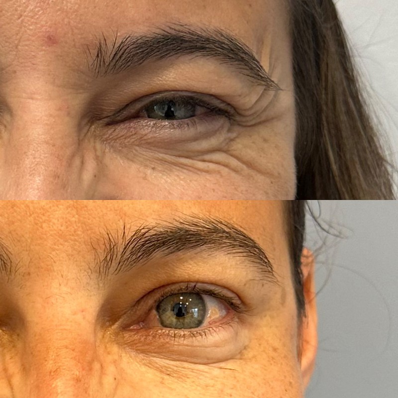 Anti-wrinkle treatment for crows feet