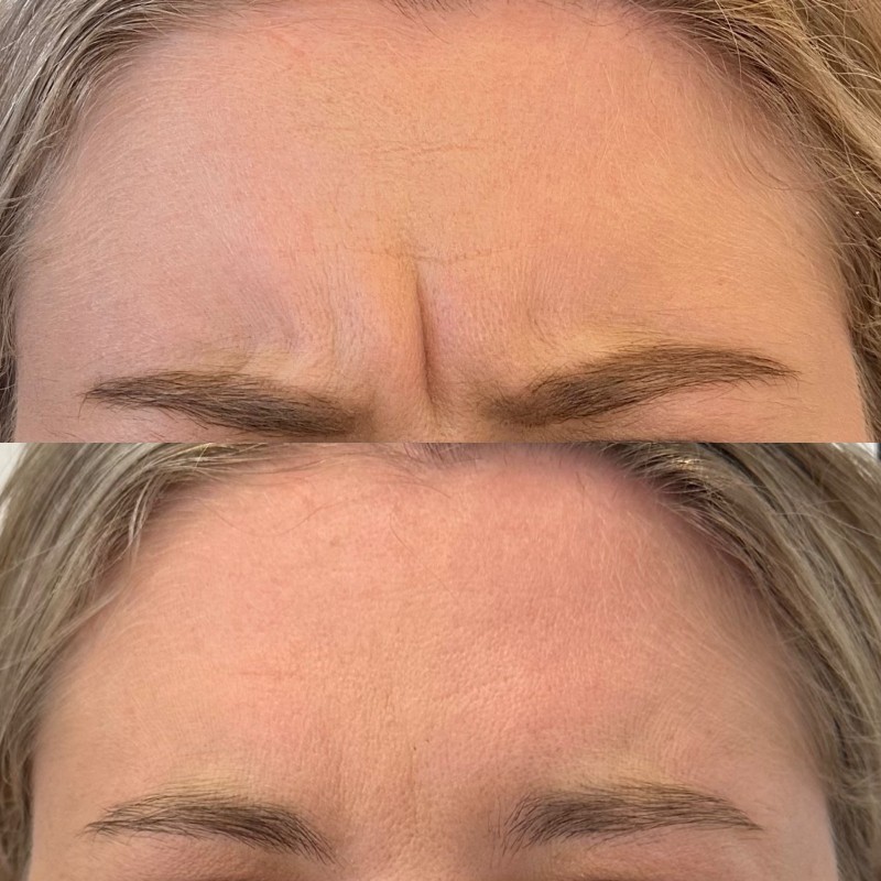 Anti-wrinkle treatment for frown lines
