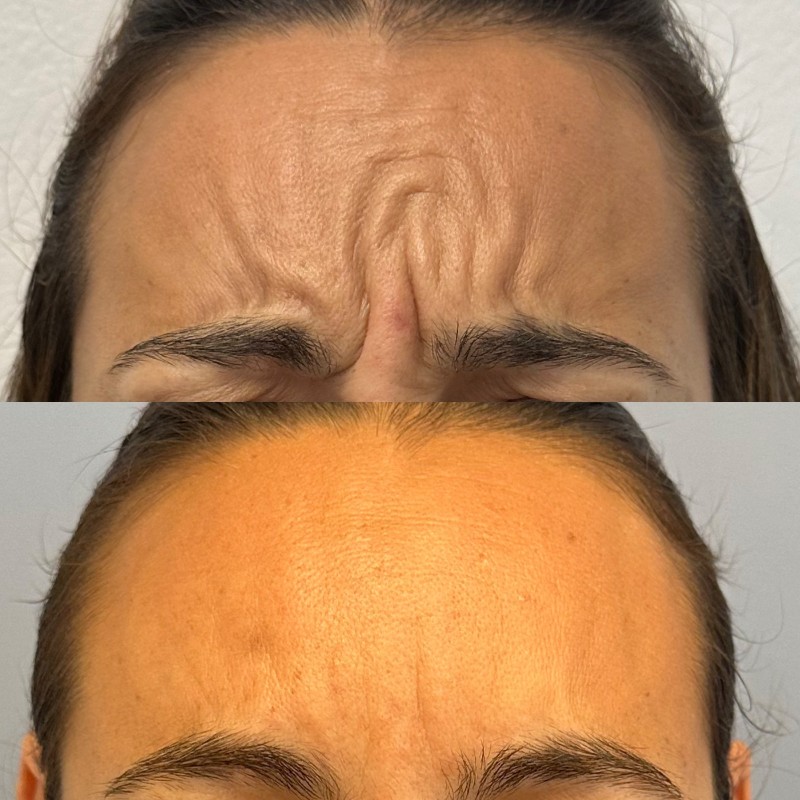 Anti-wrinkle treatment in forehead_2
